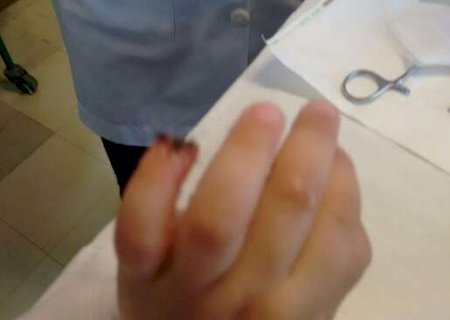 Justiça manda indenizar menino que teve parte do dedo amputado em Emei