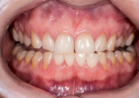 Conheça os hábitos que podem estar por trás da erosão dentária