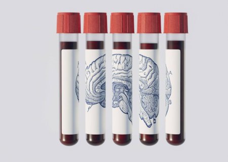 Exame de sangue promete prever Alzheimer anos antes; entenda por que médicos pedem cautela
